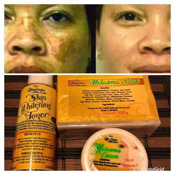 toner melasma